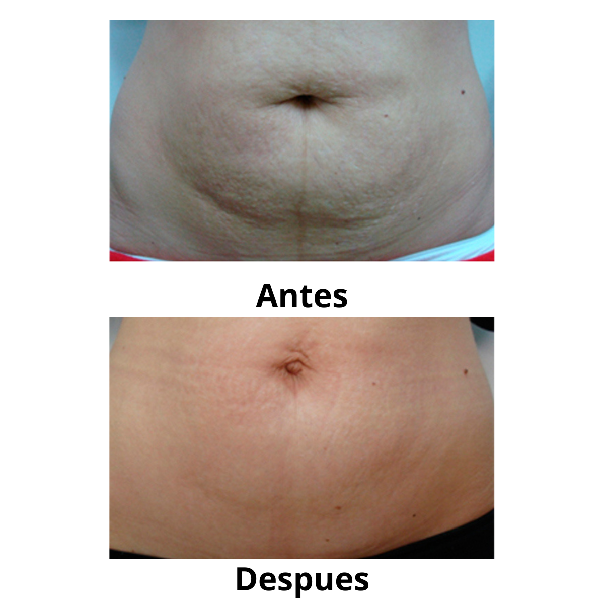 Crema Corporal para Masajes Anti Estrías